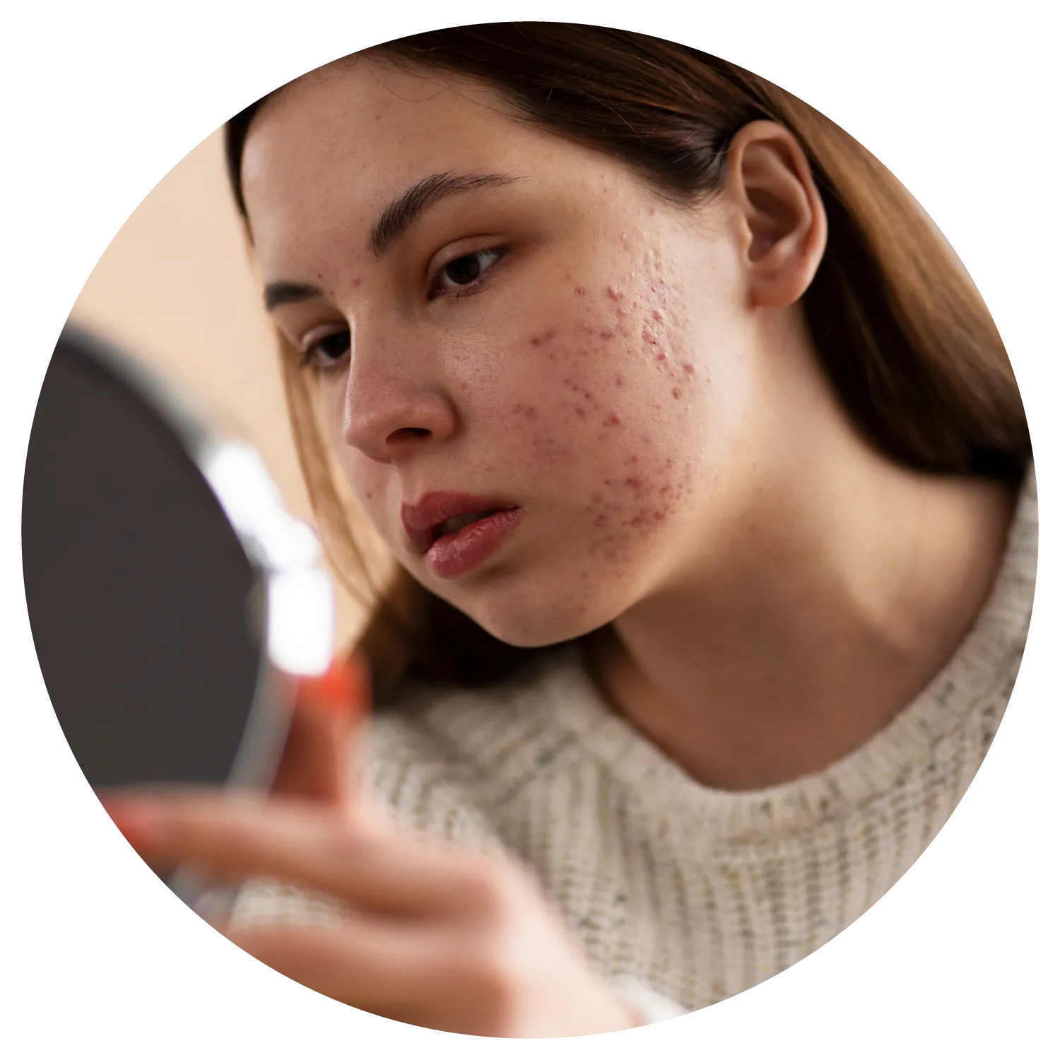 Acne Scarring treatment results at Toronto medical spa - The Chain Reaction of Symptoms